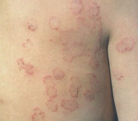 银屑病图片初期症状，红疹出现白屑薄膜出血点